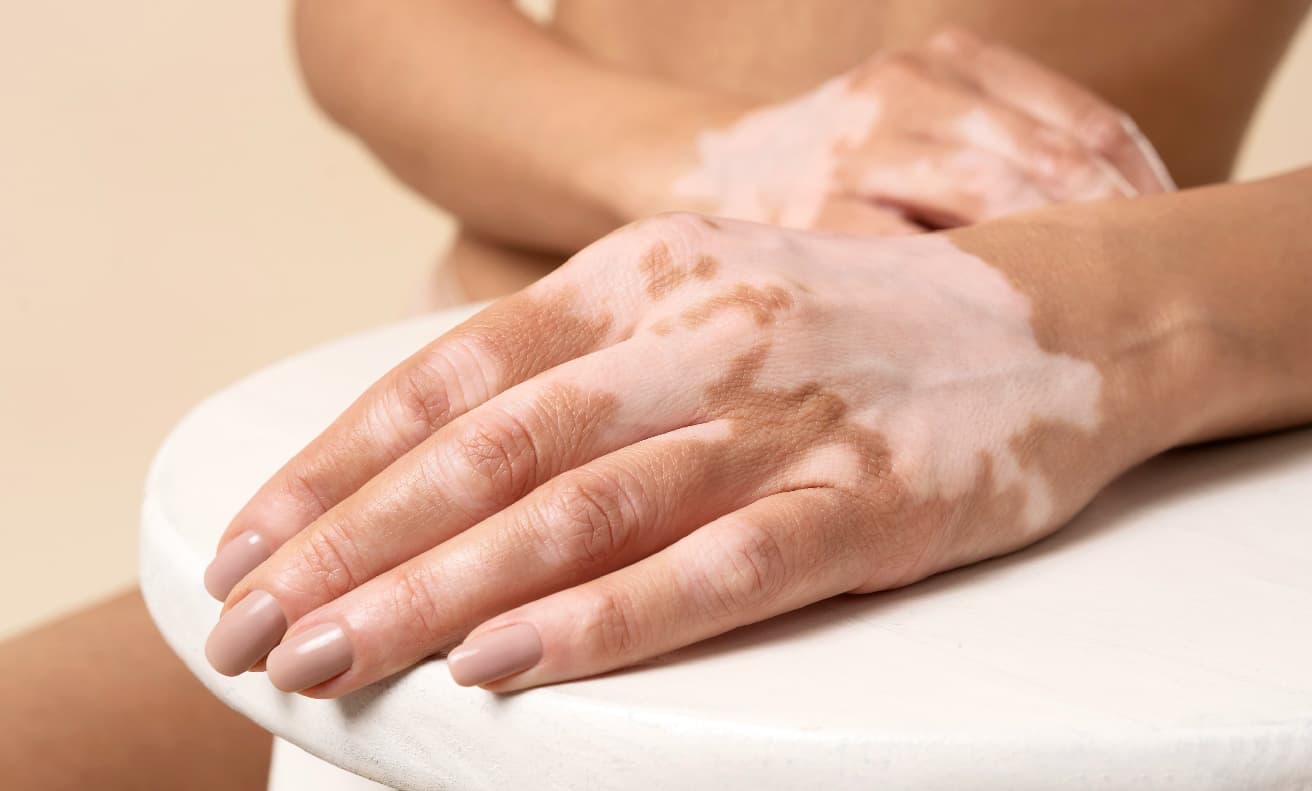 CSS inaugura su primera cabina de fototerapia para tratamientos dermatológicos